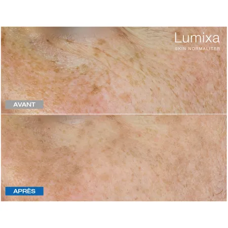 Pack LED Kn7000d X Lumixa • Fb Dermatology X Proshape Action Skin Normaliser