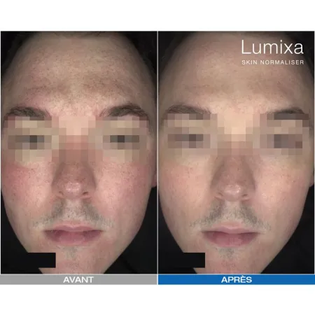 Pack LED Kn7000d X Lumixa • Fb Dermatology X Proshape Action Skin Normaliser