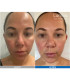 Pack LED Kn7000d X Lumixa • Fb Dermatology X Proshape Action Skin Normaliser