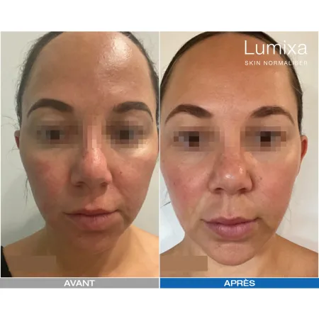 Pack LED Kn7000d X Lumixa • Fb Dermatology X Proshape Action Skin Normaliser