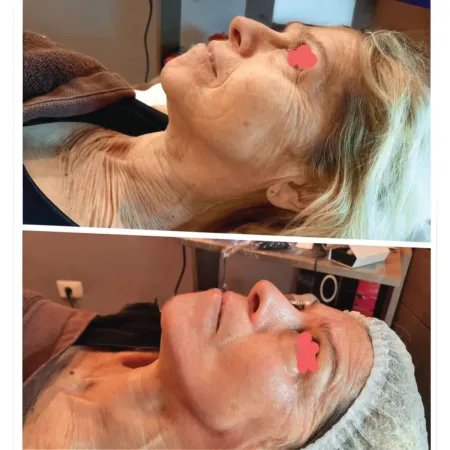 Embouts 1Need Pro x10 - Appareils Minceur et Anti-âge ProShape - Beauty Tech