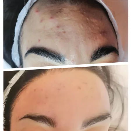 Embouts 1Need Pro x10 - Appareils Minceur et Anti-âge ProShape - Beauty Tech