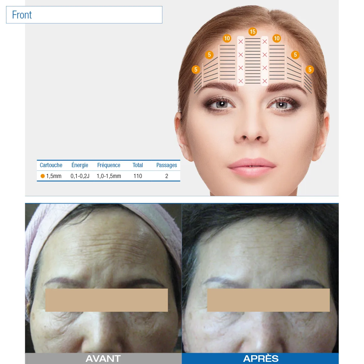 Ultraformer III - Appareil de démo - Pro - Beauty Tech