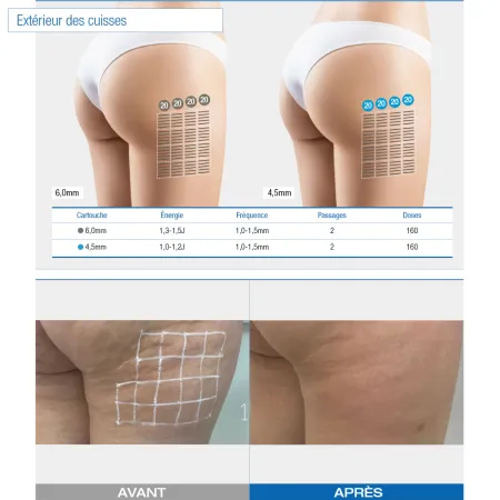Ultraformer III - Appareil de démo - Pro - Beauty Tech