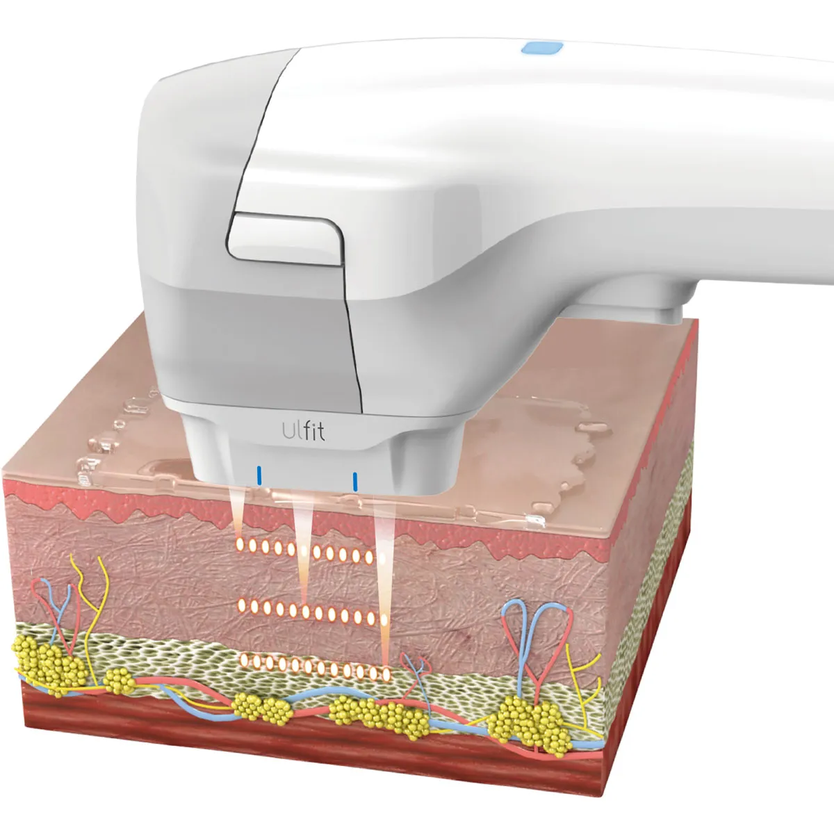 Ulfit - Appareil de démo • ProShape - Pro - Beauty Tech