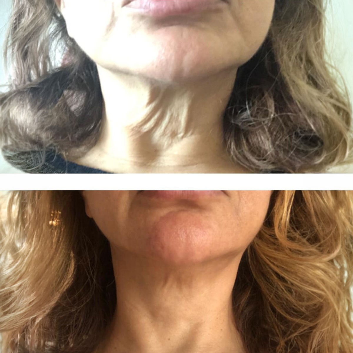 Veloce BBL - Appareils de soin du visage professionnels - Beauty Tech