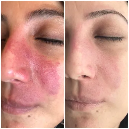 Veloce - Appareils de soin du visage professionnels - Beauty Tech