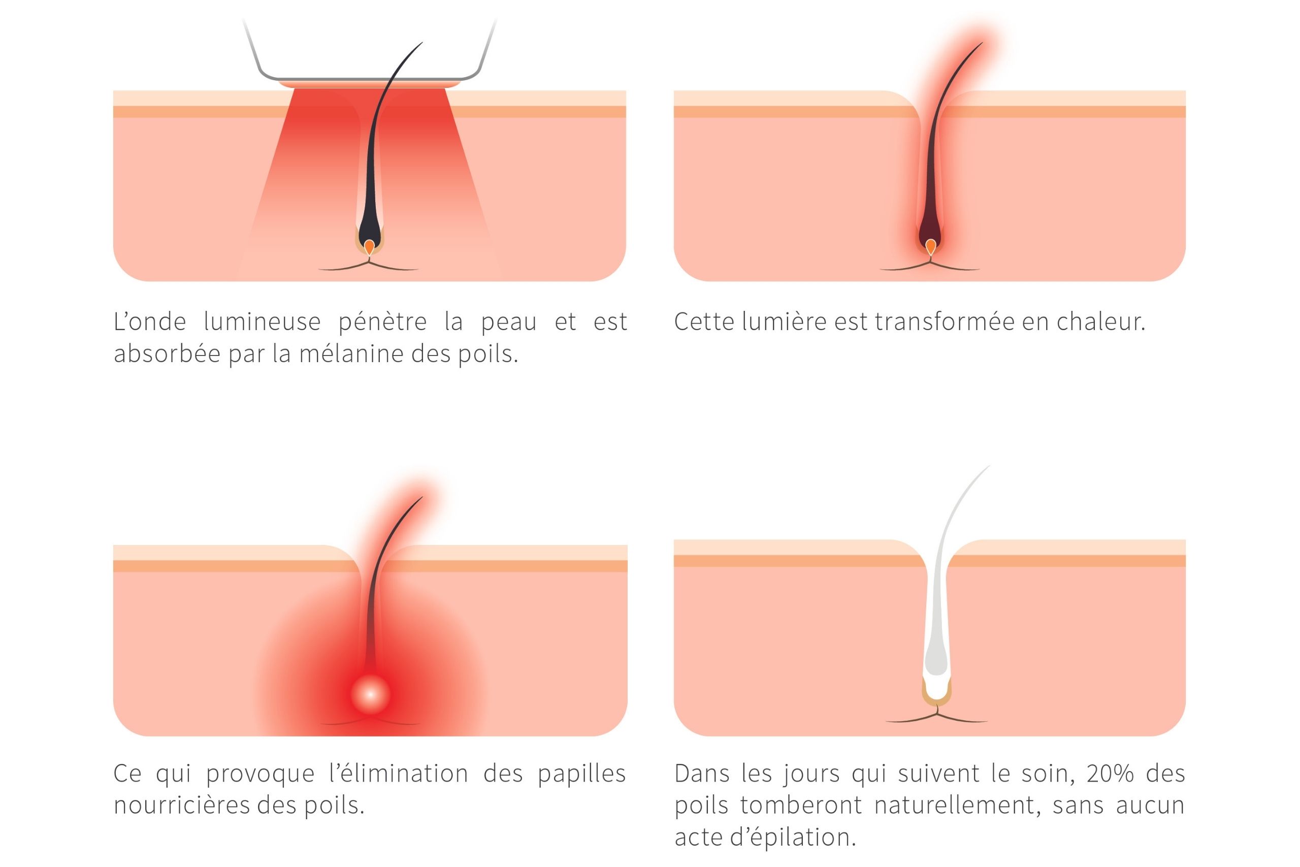 Epilation définitive : choisir entre laser ou lumière pulsée (IPL